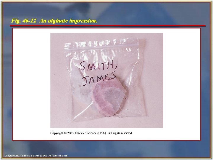 Fig. 46 -12 An alginate impression. Copyright 2003, Elsevier Science (USA). All rights reserved.
