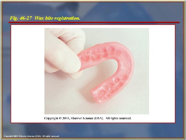 Fig. 46 -27 Wax bite registration. Copyright 2003, Elsevier Science (USA). All rights reserved.