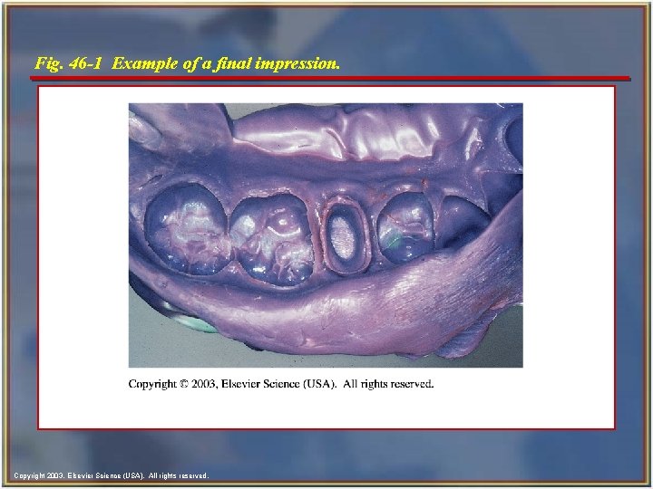 Fig. 46 -1 Example of a final impression. Copyright 2003, Elsevier Science (USA). All