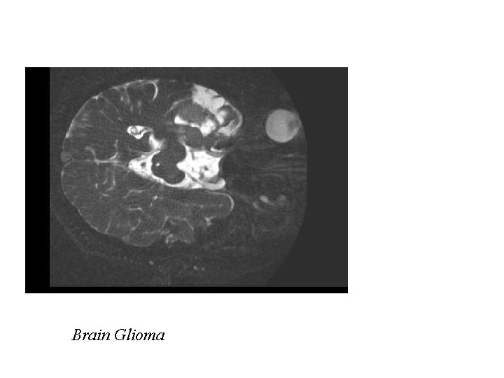 Brain Glioma 