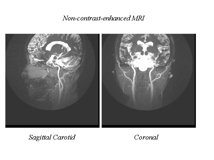 Non-contrast-enhanced MRI Sagittal Carotid Coronal 