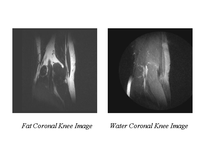 Fat Coronal Knee Image Water Coronal Knee Image 