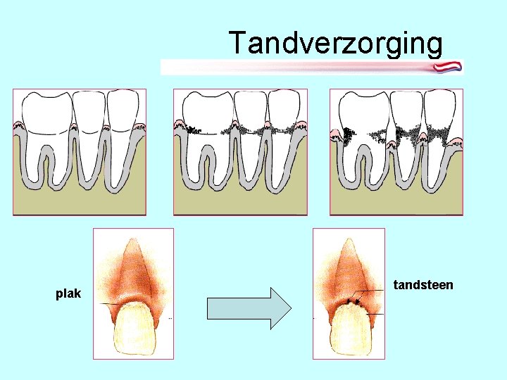 Tandverzorging plak tandsteen 
