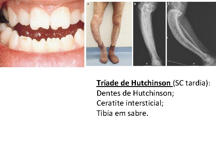 Tríade de Hutchinson (SC tardia): Dentes de Hutchinson; Ceratite intersticial; Tíbia em sabre. 