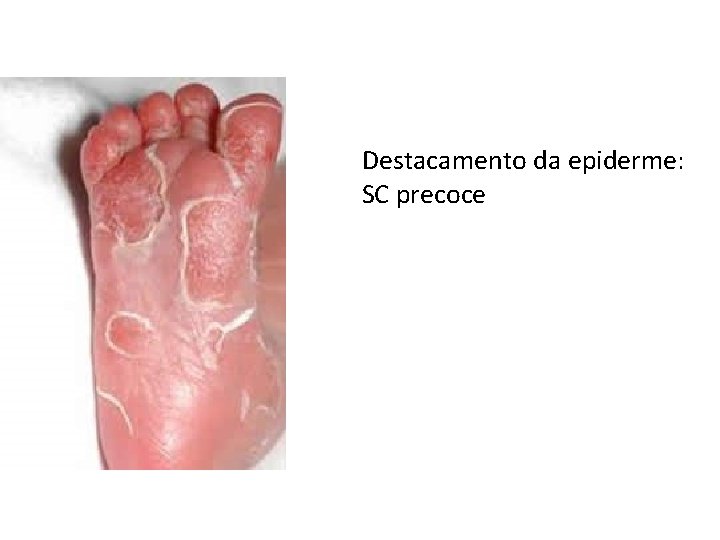 Destacamento da epiderme: SC precoce 