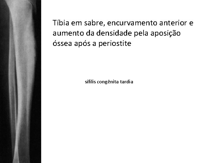 Tíbia em sabre, encurvamento anterior e aumento da densidade pela aposição óssea após a