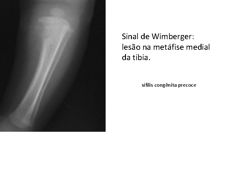 Sinal de Wimberger: lesão na metáfise medial da tibia. sífilis congênita precoce 