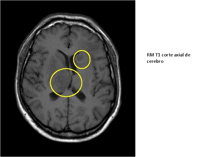 RM T 1 corte axial de cerebro 