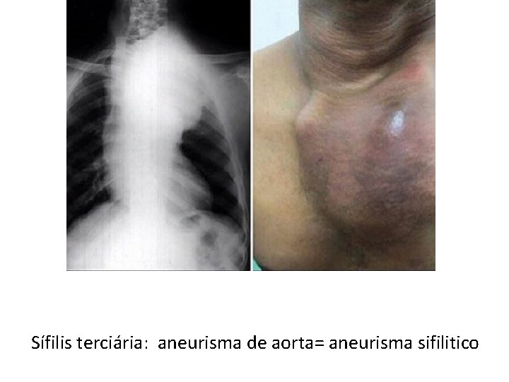 Sífilis terciária: aneurisma de aorta= aneurisma sifilitico 