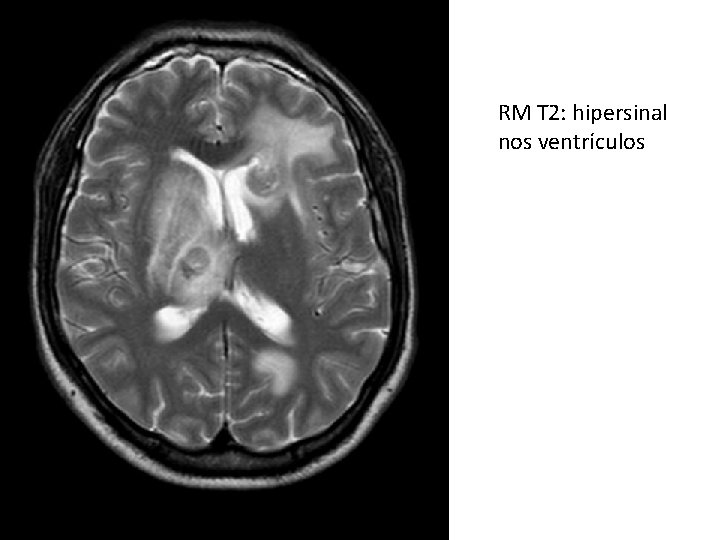 RM T 2: hipersinal nos ventrículos 