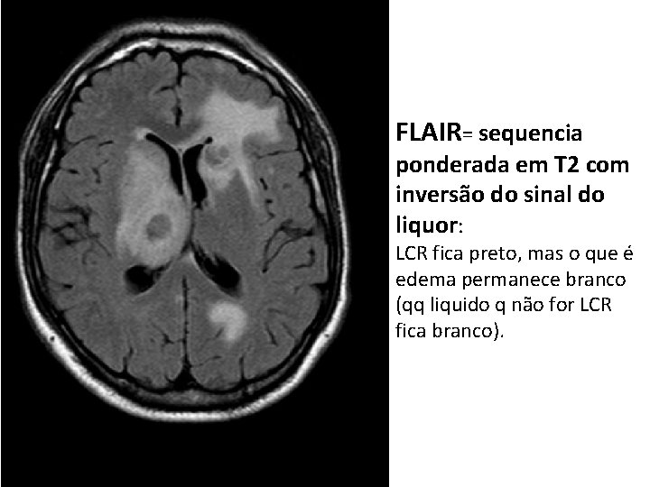 FLAIR= sequencia ponderada em T 2 com inversão do sinal do liquor: LCR fica