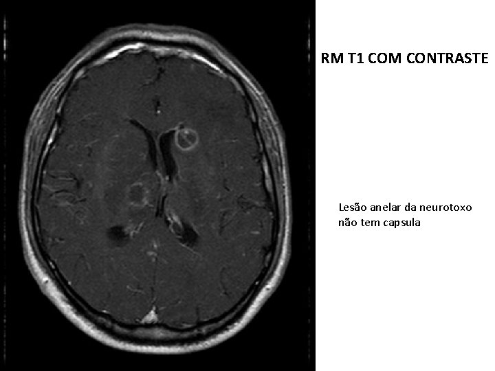 RM T 1 COM CONTRASTE Lesão anelar da neurotoxo não tem capsula 