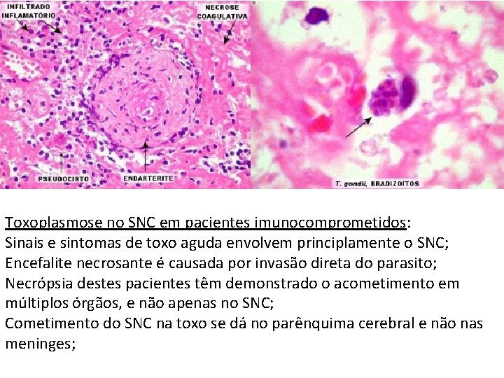 Toxoplasmose no SNC em pacientes imunocomprometidos: Sinais e sintomas de toxo aguda envolvem principlamente