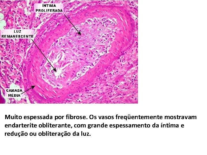 Muito espessada por fibrose. Os vasos freqüentemente mostravam endarterite obliterante, com grande espessamento da