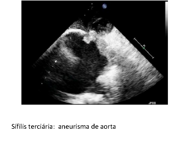 Sífilis terciária: aneurisma de aorta 