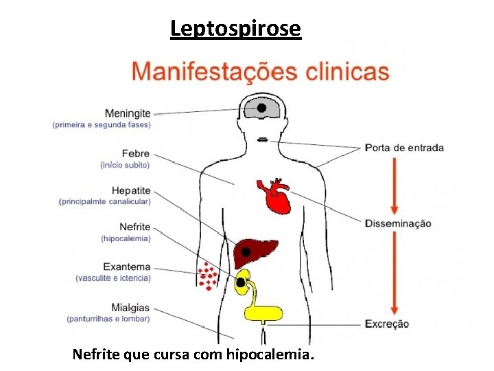 Leptospirose Nefrite que cursa com hipocalemia. 