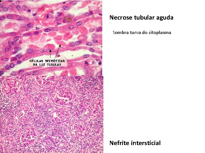 Necrose tubular aguda Sombra turva do citoplasma Nefrite intersticial 