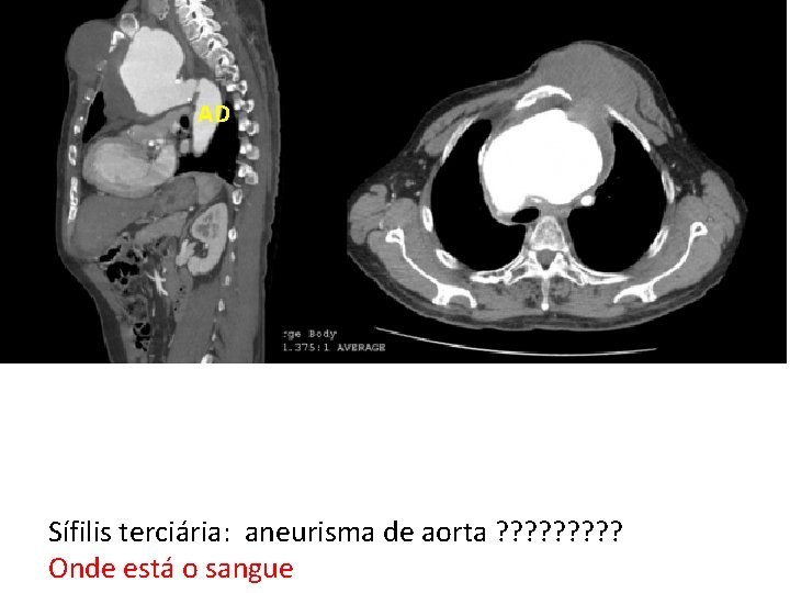 AD Sífilis terciária: aneurisma de aorta ? ? ? ? ? Onde está o