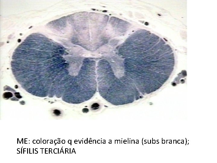 ME: coloração q evidência a mielina (subs branca); SÍFILIS TERCIÁRIA 