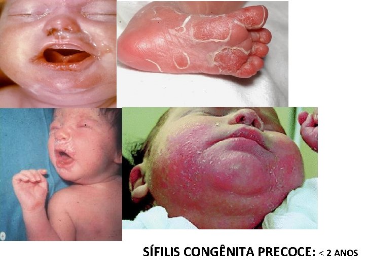 SÍFILIS CONGÊNITA PRECOCE: < 2 ANOS 