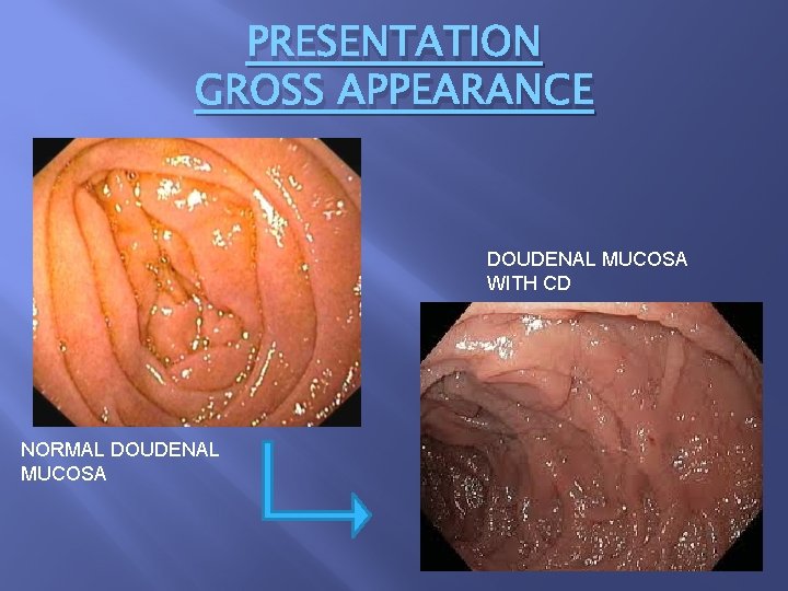 PRESENTATION GROSS APPEARANCE DOUDENAL MUCOSA WITH CD NORMAL DOUDENAL MUCOSA 