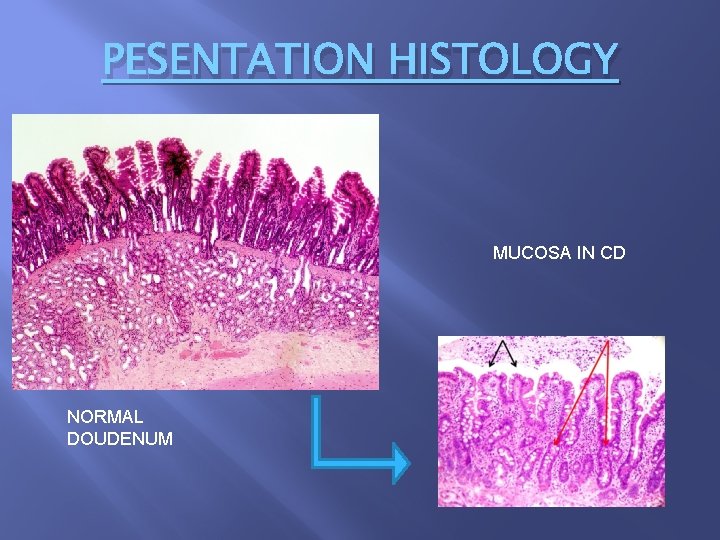 PESENTATION HISTOLOGY MUCOSA IN CD NORMAL DOUDENUM 