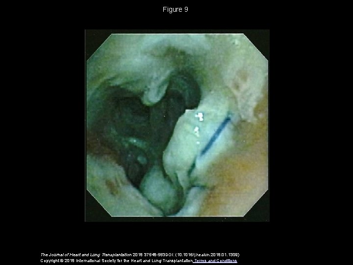Figure 9 The Journal of Heart and Lung Transplantation 2018 37548 -563 DOI: (10.