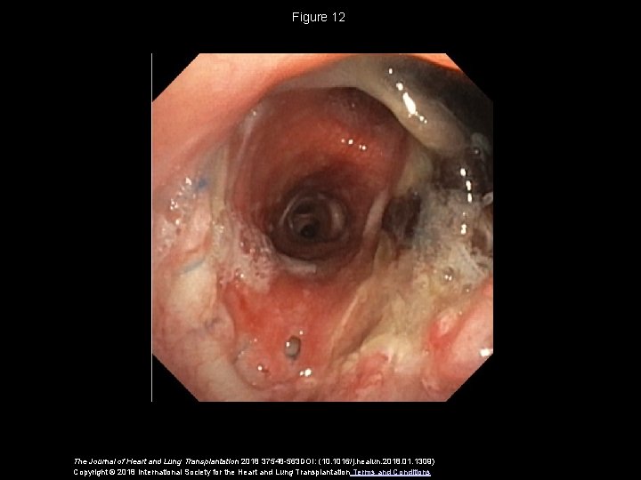 Figure 12 The Journal of Heart and Lung Transplantation 2018 37548 -563 DOI: (10.