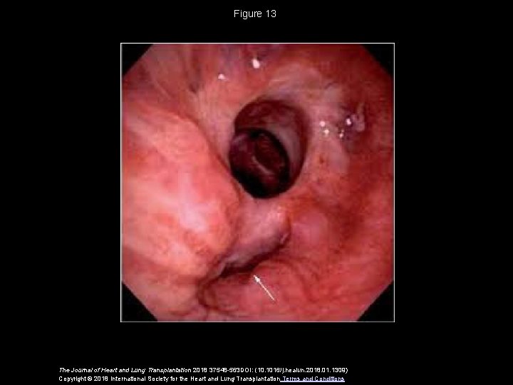 Figure 13 The Journal of Heart and Lung Transplantation 2018 37548 -563 DOI: (10.