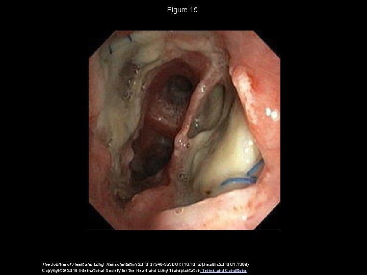 Figure 15 The Journal of Heart and Lung Transplantation 2018 37548 -563 DOI: (10.