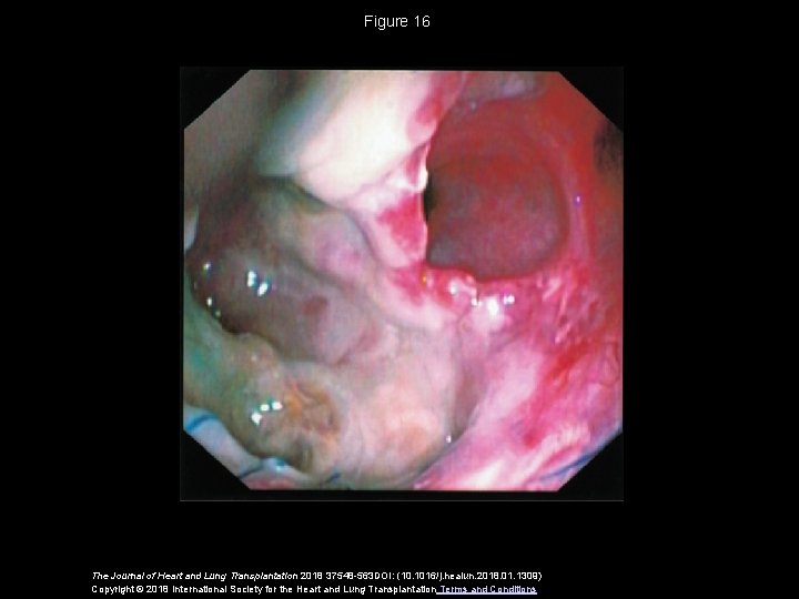 Figure 16 The Journal of Heart and Lung Transplantation 2018 37548 -563 DOI: (10.