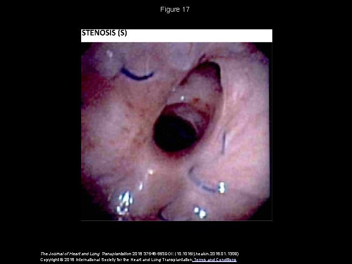 Figure 17 The Journal of Heart and Lung Transplantation 2018 37548 -563 DOI: (10.
