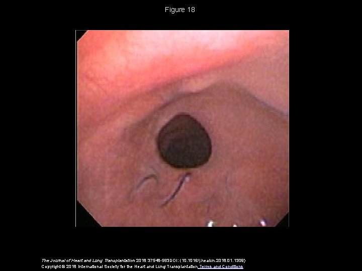 Figure 18 The Journal of Heart and Lung Transplantation 2018 37548 -563 DOI: (10.