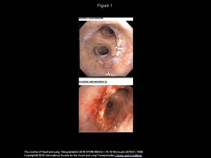 Figure 1 The Journal of Heart and Lung Transplantation 2018 37548 -563 DOI: (10.