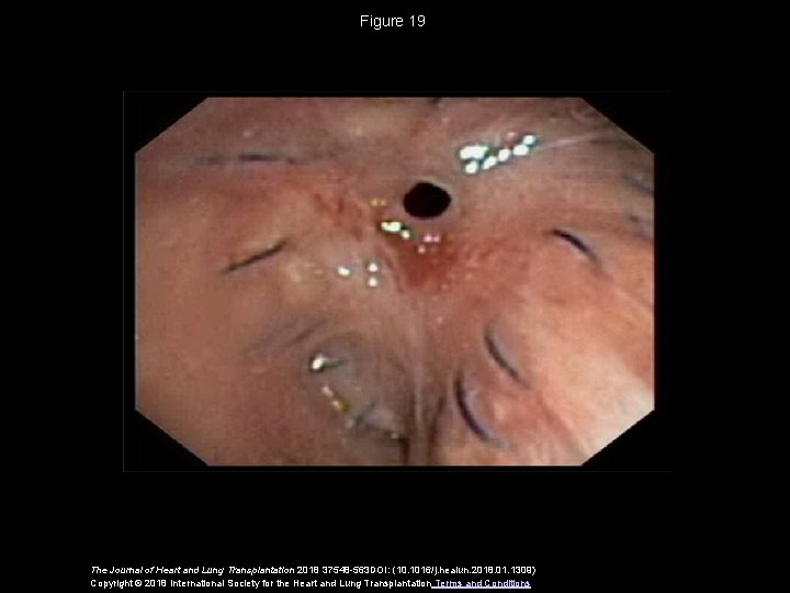 Figure 19 The Journal of Heart and Lung Transplantation 2018 37548 -563 DOI: (10.