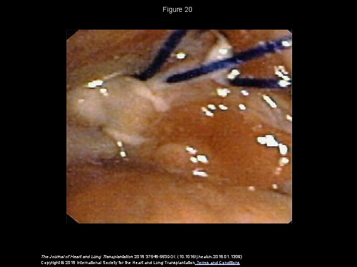 Figure 20 The Journal of Heart and Lung Transplantation 2018 37548 -563 DOI: (10.