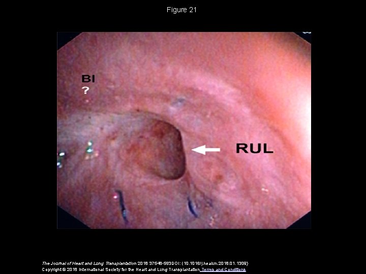 Figure 21 The Journal of Heart and Lung Transplantation 2018 37548 -563 DOI: (10.