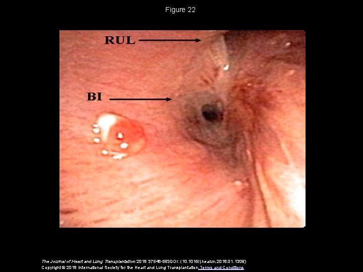 Figure 22 The Journal of Heart and Lung Transplantation 2018 37548 -563 DOI: (10.
