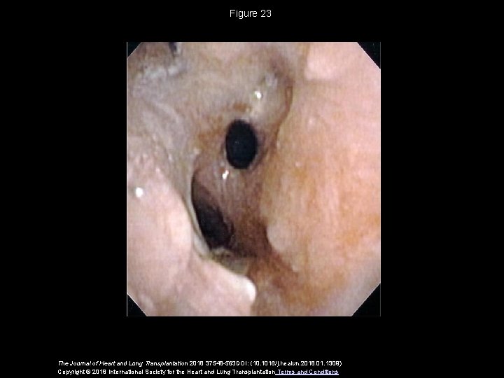 Figure 23 The Journal of Heart and Lung Transplantation 2018 37548 -563 DOI: (10.