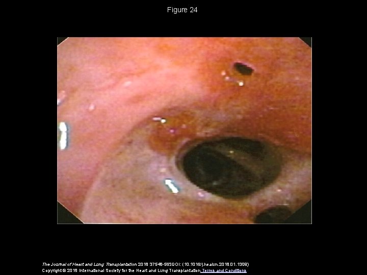 Figure 24 The Journal of Heart and Lung Transplantation 2018 37548 -563 DOI: (10.