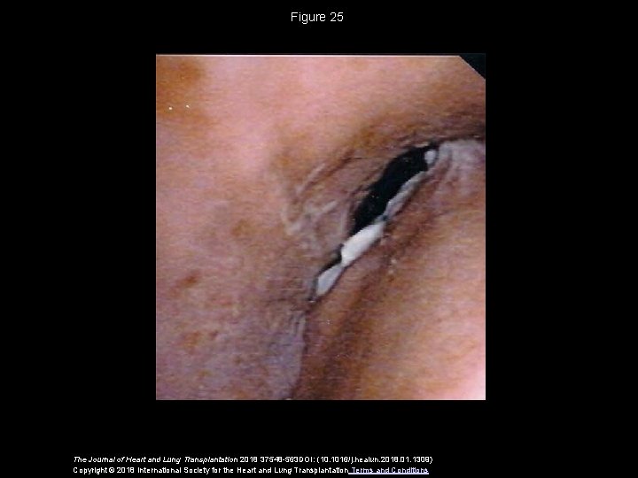 Figure 25 The Journal of Heart and Lung Transplantation 2018 37548 -563 DOI: (10.