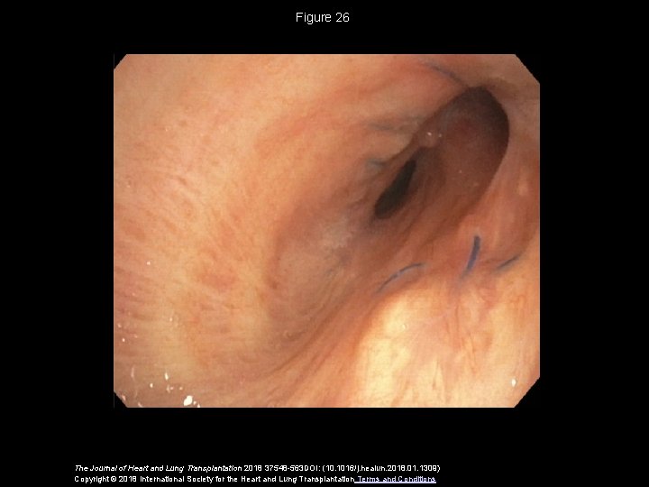 Figure 26 The Journal of Heart and Lung Transplantation 2018 37548 -563 DOI: (10.