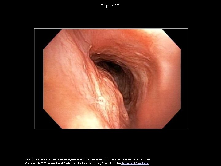 Figure 27 The Journal of Heart and Lung Transplantation 2018 37548 -563 DOI: (10.
