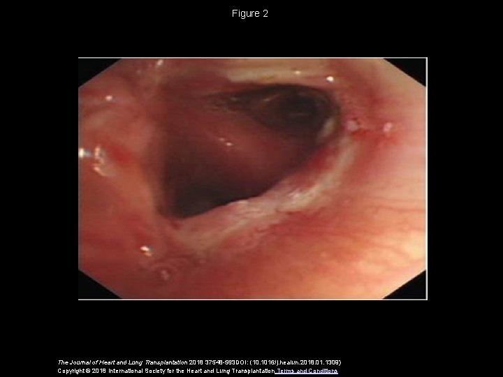 Figure 2 The Journal of Heart and Lung Transplantation 2018 37548 -563 DOI: (10.