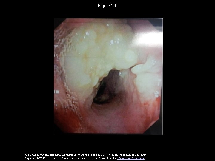 Figure 29 The Journal of Heart and Lung Transplantation 2018 37548 -563 DOI: (10.