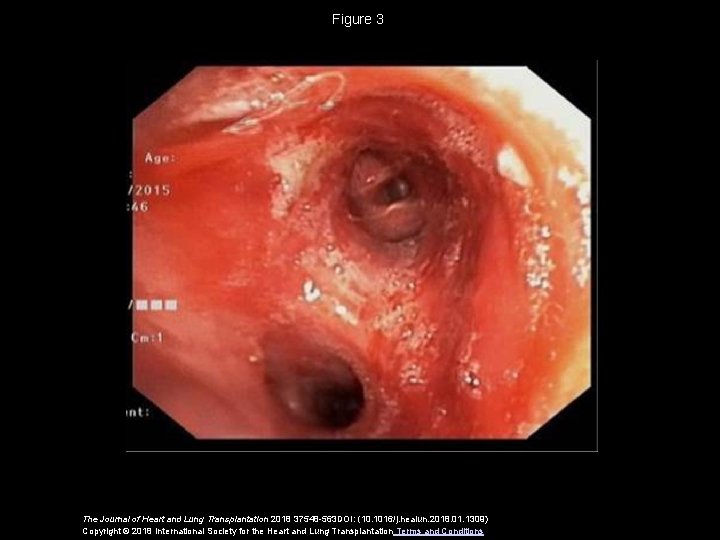 Figure 3 The Journal of Heart and Lung Transplantation 2018 37548 -563 DOI: (10.