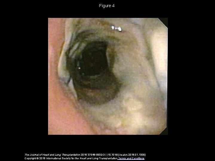 Figure 4 The Journal of Heart and Lung Transplantation 2018 37548 -563 DOI: (10.