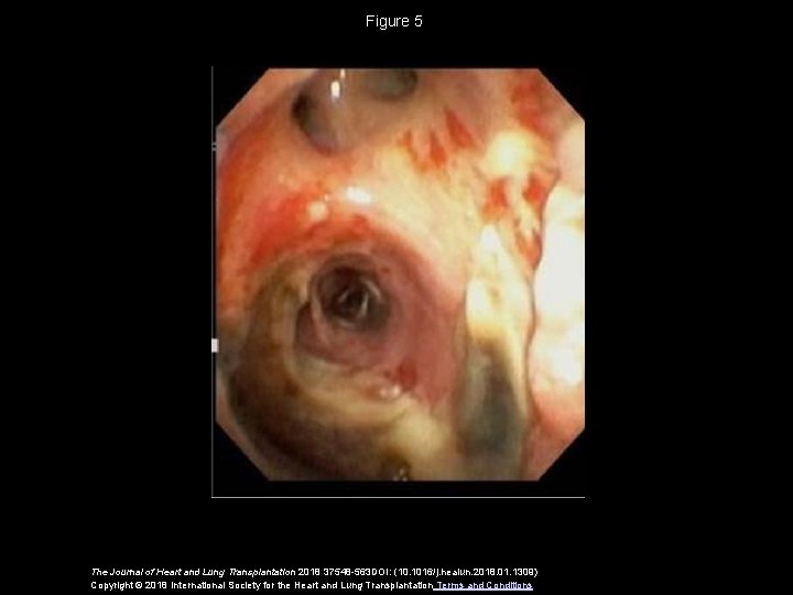 Figure 5 The Journal of Heart and Lung Transplantation 2018 37548 -563 DOI: (10.