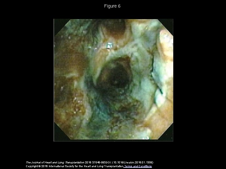 Figure 6 The Journal of Heart and Lung Transplantation 2018 37548 -563 DOI: (10.