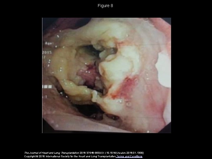 Figure 8 The Journal of Heart and Lung Transplantation 2018 37548 -563 DOI: (10.